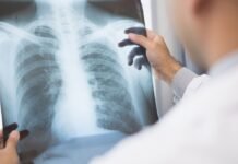 Anvisa aprova novo medicamento para câncer de pulmão avançado