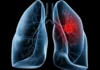 Saiba o que é adenocarcinoma pulmonar, câncer que atinge o papa