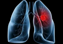 Saiba o que é adenocarcinoma pulmonar, câncer que atinge o papa
