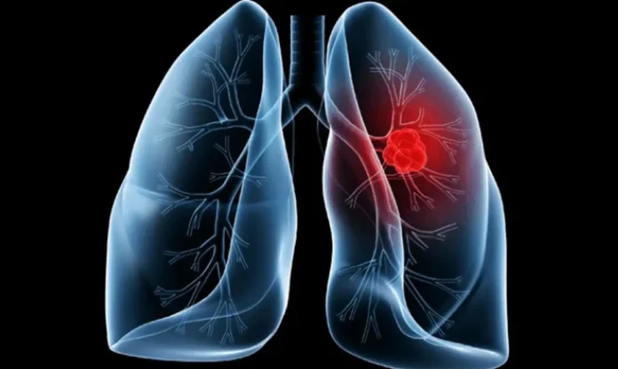 Saiba-o-que-e-adenocarcinoma-pulmonar-cancer-que-atinge-o-papa